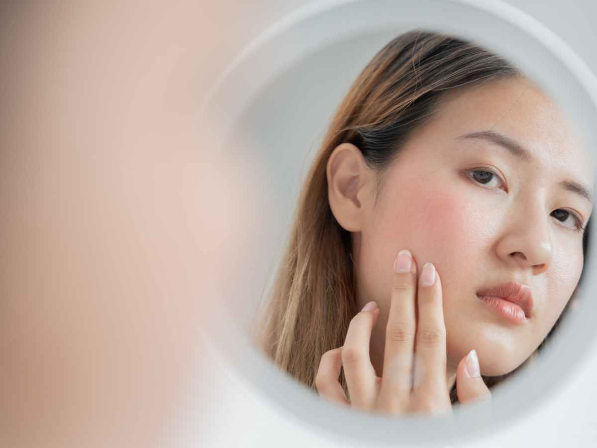 Understanding Rosacea: Comprehensive Guide to Treatment and Skincare