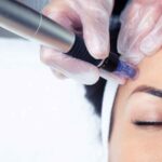 Understanding Microneedling: What It Is and Its Different Types