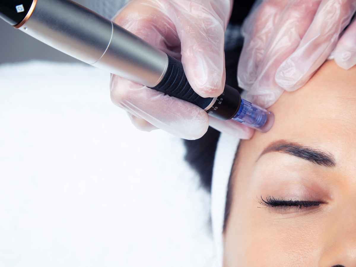 Understanding Microneedling: What It Is and Its Different Types