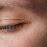 Spots and Bumps Around the Eyes: What They Are & How to get rid of them!